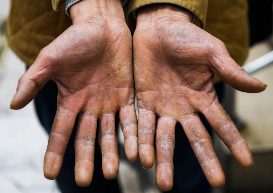 冉光辉的手掌不仅老茧多,手指关节也严重变形,如竹节般,每节指骨都向