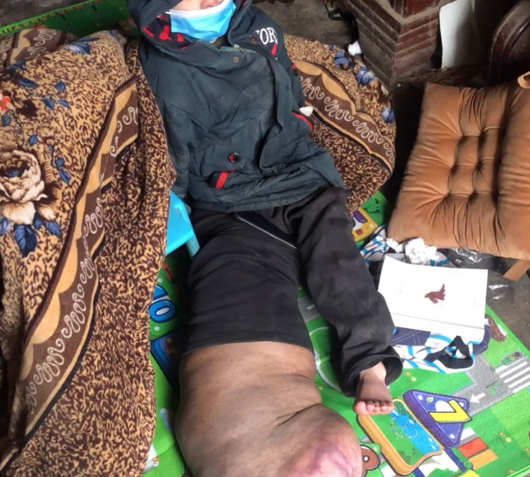 直播:12岁男孩患罕见病,右腿肿胀犹如"大象腿"-大象网