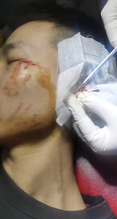 事后,同事赶紧带韦柯阳到医院治疗,脸部两道伤口较浅做了包扎,耳朵