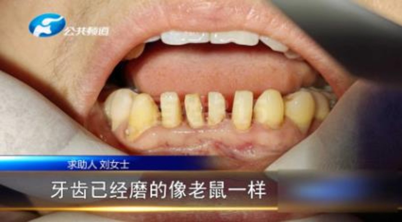患者去补牙磨成老鼠牙患者被拔掉6颗牙天天牙疼当地卫健委已对其进行