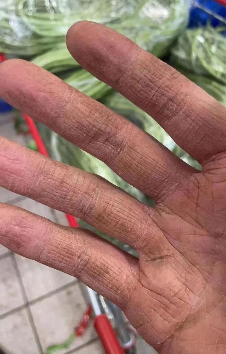 粗糙,开裂,布满干纹……这两天,一只手的照片在浙江平湖市民的朋友圈